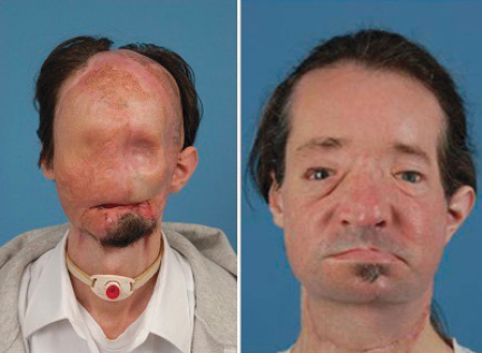 Dallas Weins, 26, pictured before and after undergoing the first full facial transplant in the U.S., in 2011
